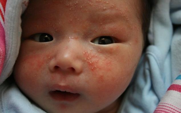 湿疹10年治愈方法,宝宝湿疹十个月了反复