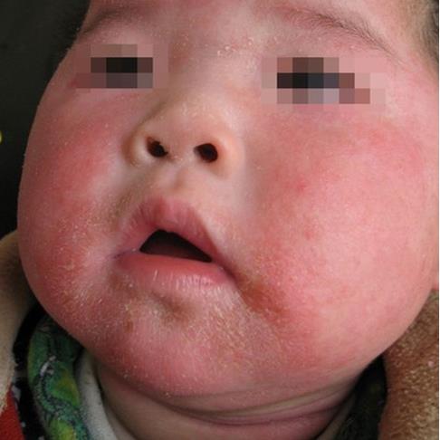 湿疹10年治愈方法,宝宝湿疹十个月了反复