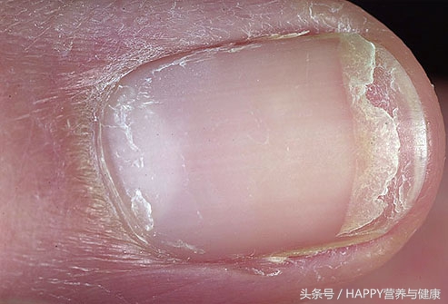 指甲边缘开裂起倒刺怎么快速补救,指甲半月牙与皮肤连接处总是开裂