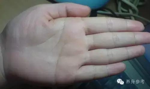 讲解脑血栓疾病的4大预防绝招,脑血栓患者秋天要关注什么