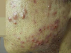 “*品毒**”引起的皮肤病变，触目惊心！