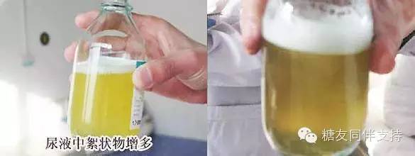 糖尿病友预防肾病，听台湾卫都师的建议