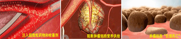 警惕癌症的三个表现,警惕肾癌3个标志性症状
