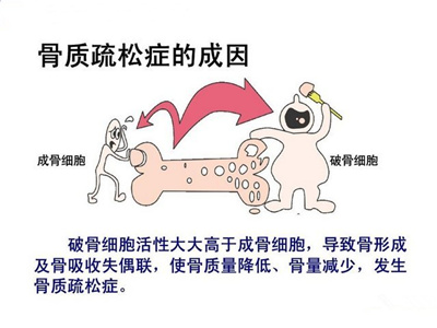 骨质疏松有哪些主要发病原因