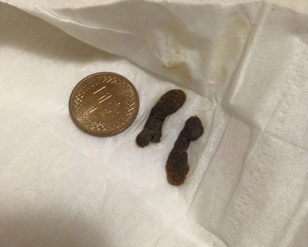 女孩耳朵里挖出石头后续,挖耳屎挖出奇怪的东西