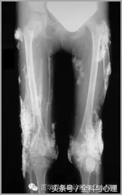 软组织钙化与骨化,软组织钙化和骨质增生