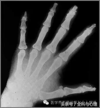 软组织钙化与骨化,软组织钙化和骨质增生