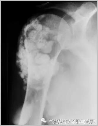 软组织钙化与骨化,软组织钙化和骨质增生