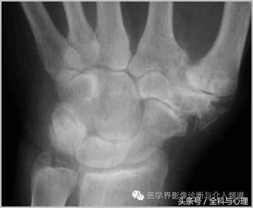 软组织钙化与骨化,软组织钙化和骨质增生