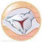 心脏支架说明书,这份通俗易懂的心脏说明书请收好