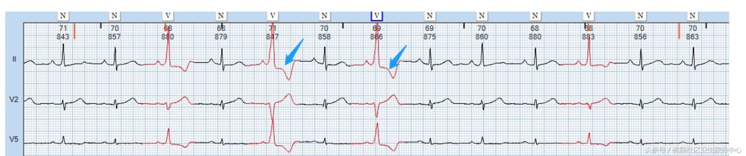 继发性stt异常是什么意思,心电图继发性st-t改变是什么意思