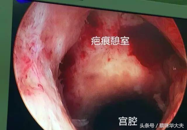 13周胎盘下缘达宫颈内口腹痛,怀孕13周胎盘覆盖宫颈内口严重吗