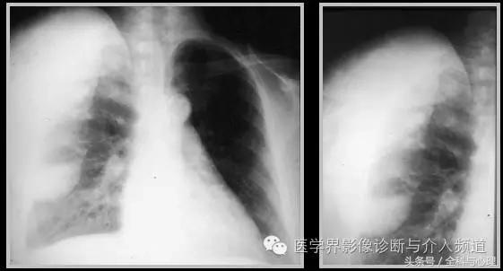 软组织钙化与骨化,软组织钙化和骨质增生