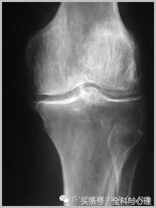 软组织钙化与骨化,软组织钙化和骨质增生