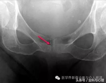 软组织钙化与骨化,软组织钙化和骨质增生