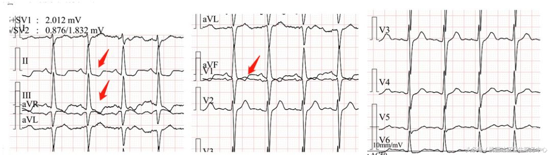 继发性stt异常是什么意思,心电图继发性st-t改变是什么意思