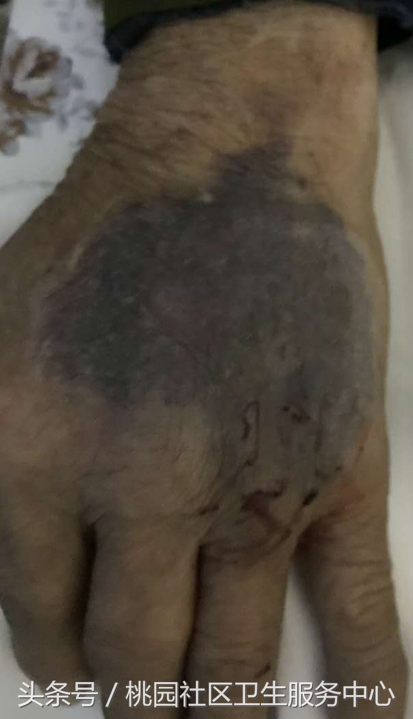 输液手背淤青疼怎么办,输液拔针后手背有淤血怎么处理