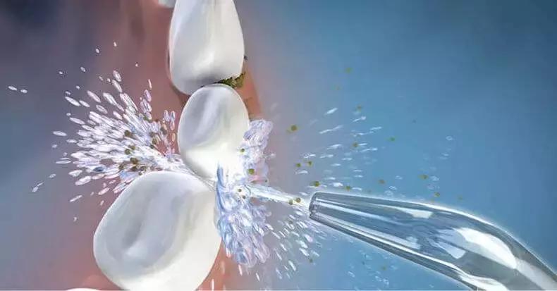 你应该知道的洁牙知识都在这里了,你应该知道的口腔小知识