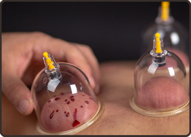 拔火罐关注事项和禁忌,高血压拔火罐关注事项