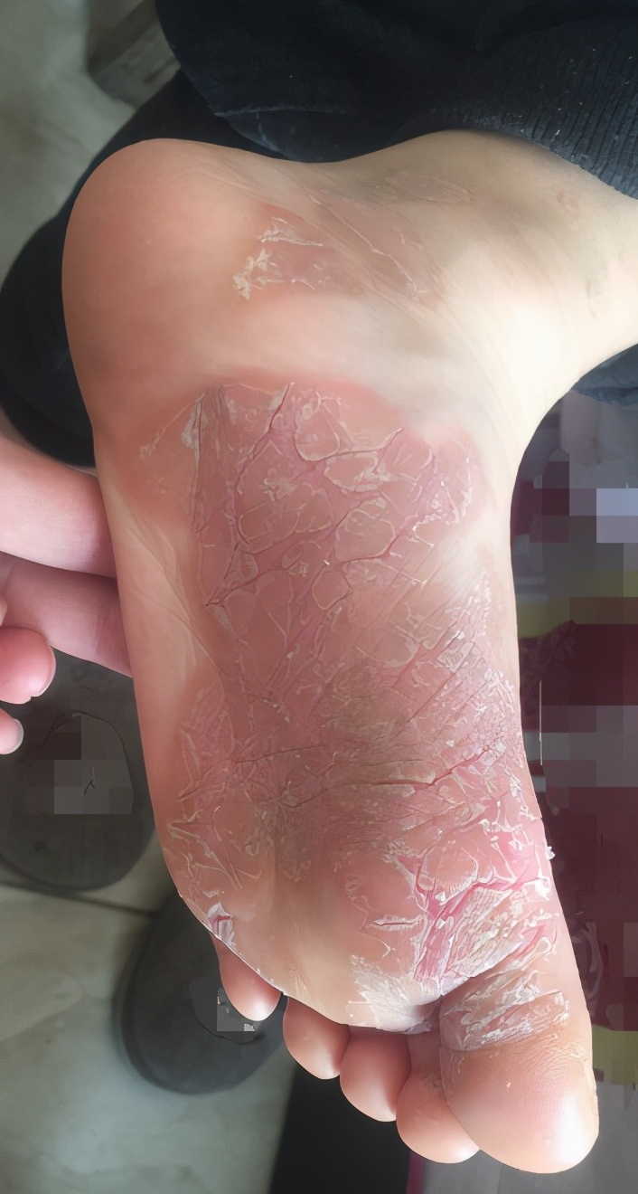 泡醋可以止足癣痒，但治标不治本