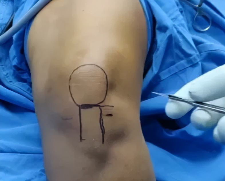 关节镜的适应症是什么,关节镜操作流程及关注事项