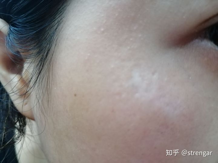 陈金西细胞祛疤真实性,陈金西细胞种植毁容