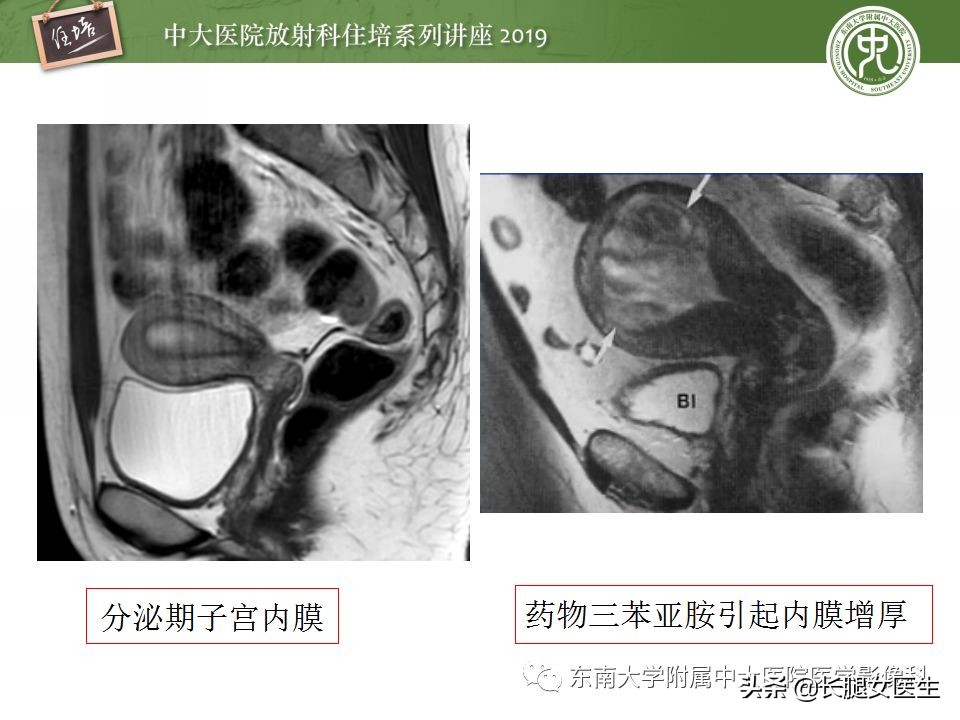 女性生殖子宫影像解剖及生理改变