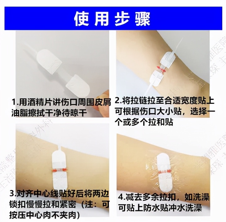 解析疤痕的非手术治疗,医美疤痕修复