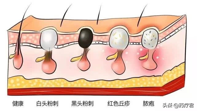 鼻子毛孔粗大黑头多是草莓鼻吗,挤黑头草莓鼻造成毛孔粗大怎么办