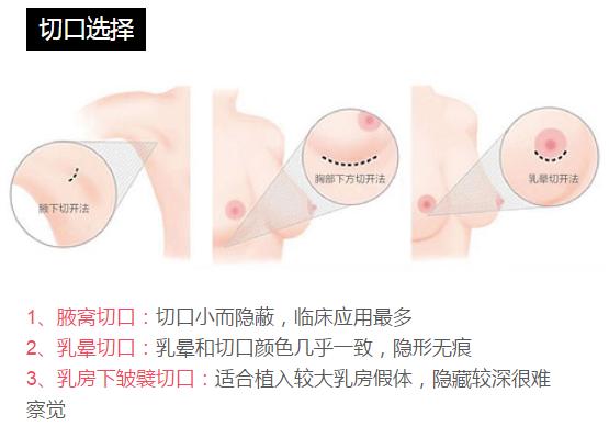 宁波假体隆胸维持时间,蓝贝假体隆胸维持多久