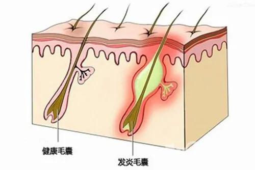 油腻脂溢性脱发,脂溢性脱发怎么抑制出油