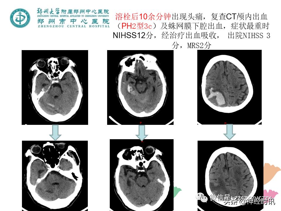 静脉溶栓怎么引起的,静脉相关并发症的预防及处理