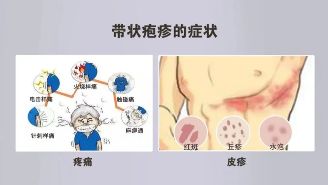 「中山医“声”」疼痛难忍？不能再忍！专家支招带状疱疹神经痛