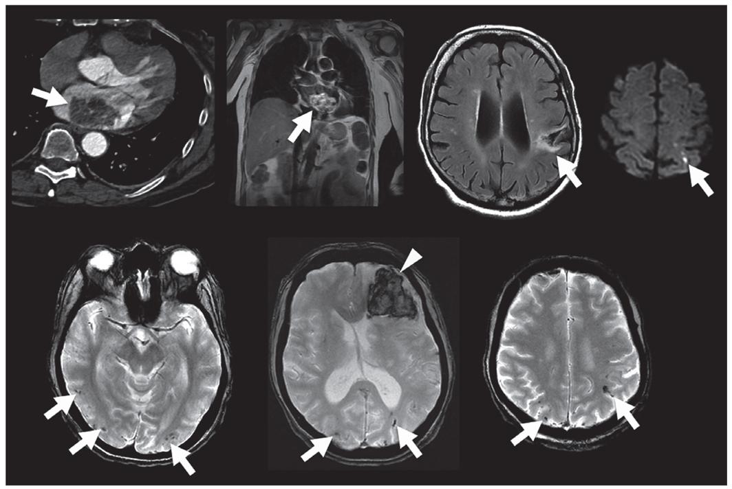 头疼做磁共振脑小血管有点出血,核磁共振说脑血管出血