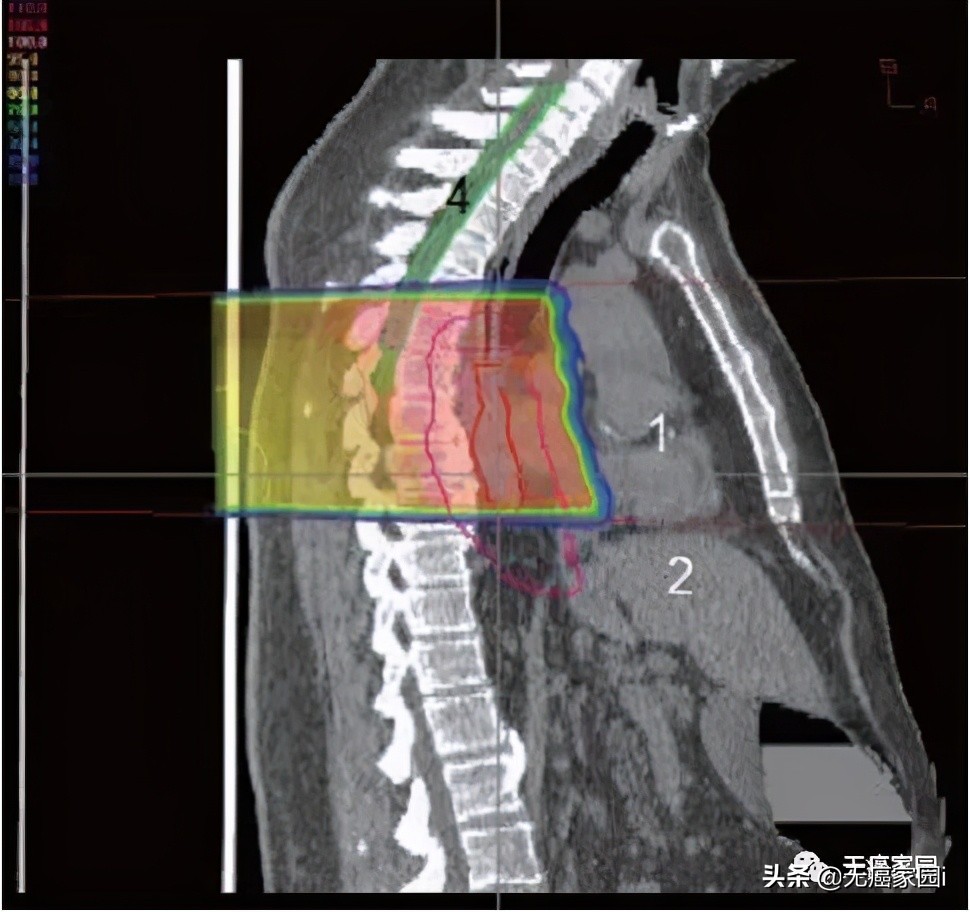 质子治疗消化道肿瘤,质子重离子治疗肠胃瘤