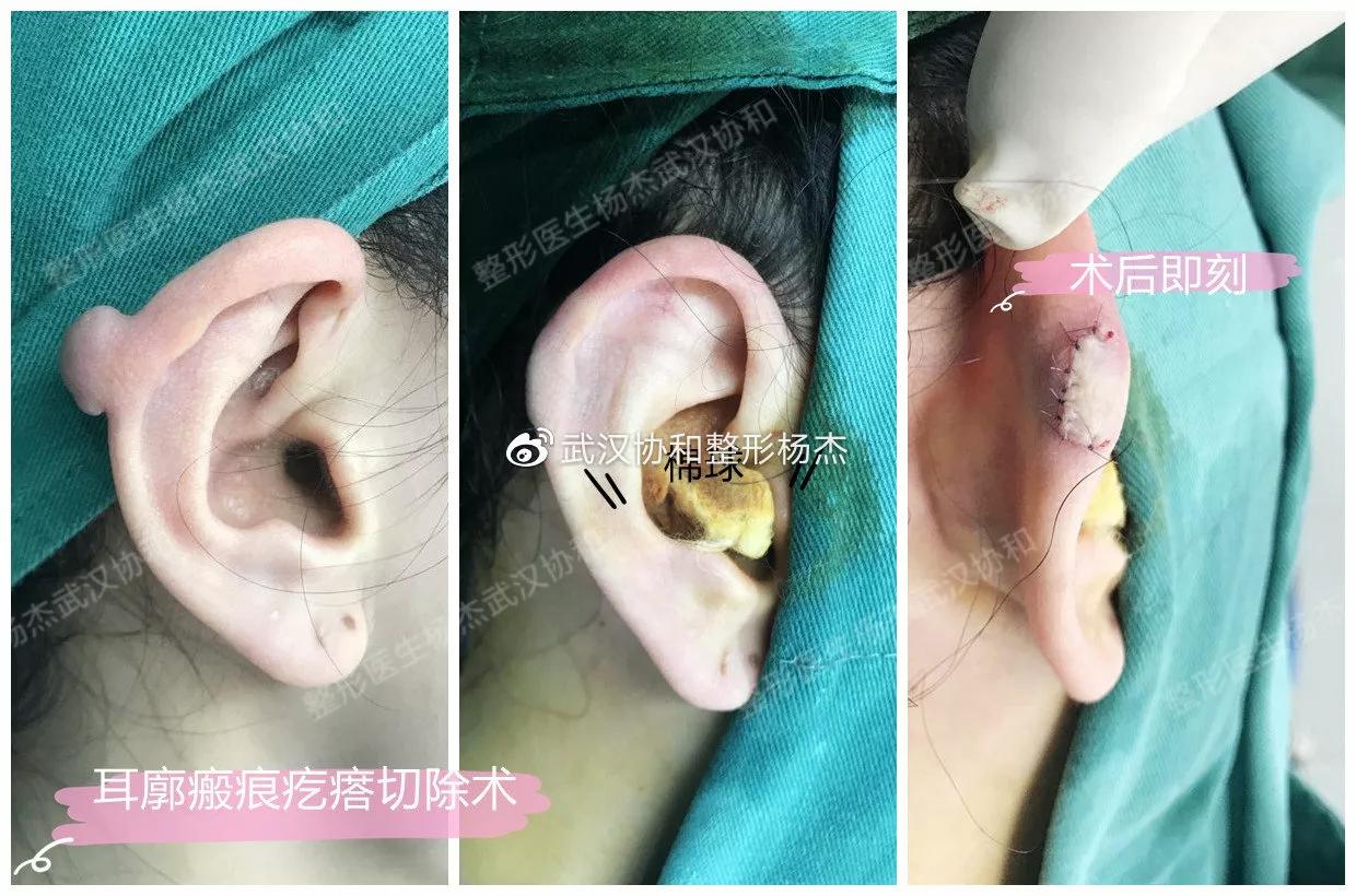 疤痕体质可以做全切双眼皮吗,疤痕体质可以做埋线双眼皮吗