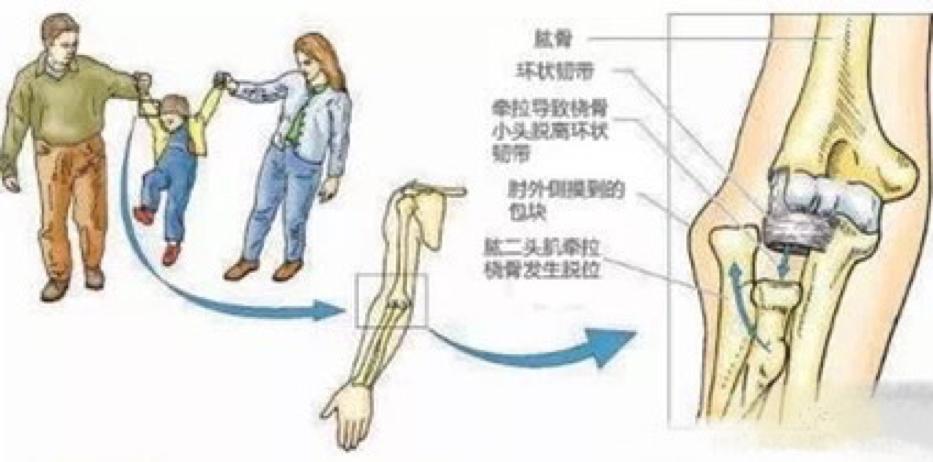 婴儿突然手臂无法动,小儿桡骨头半脱位关注事项