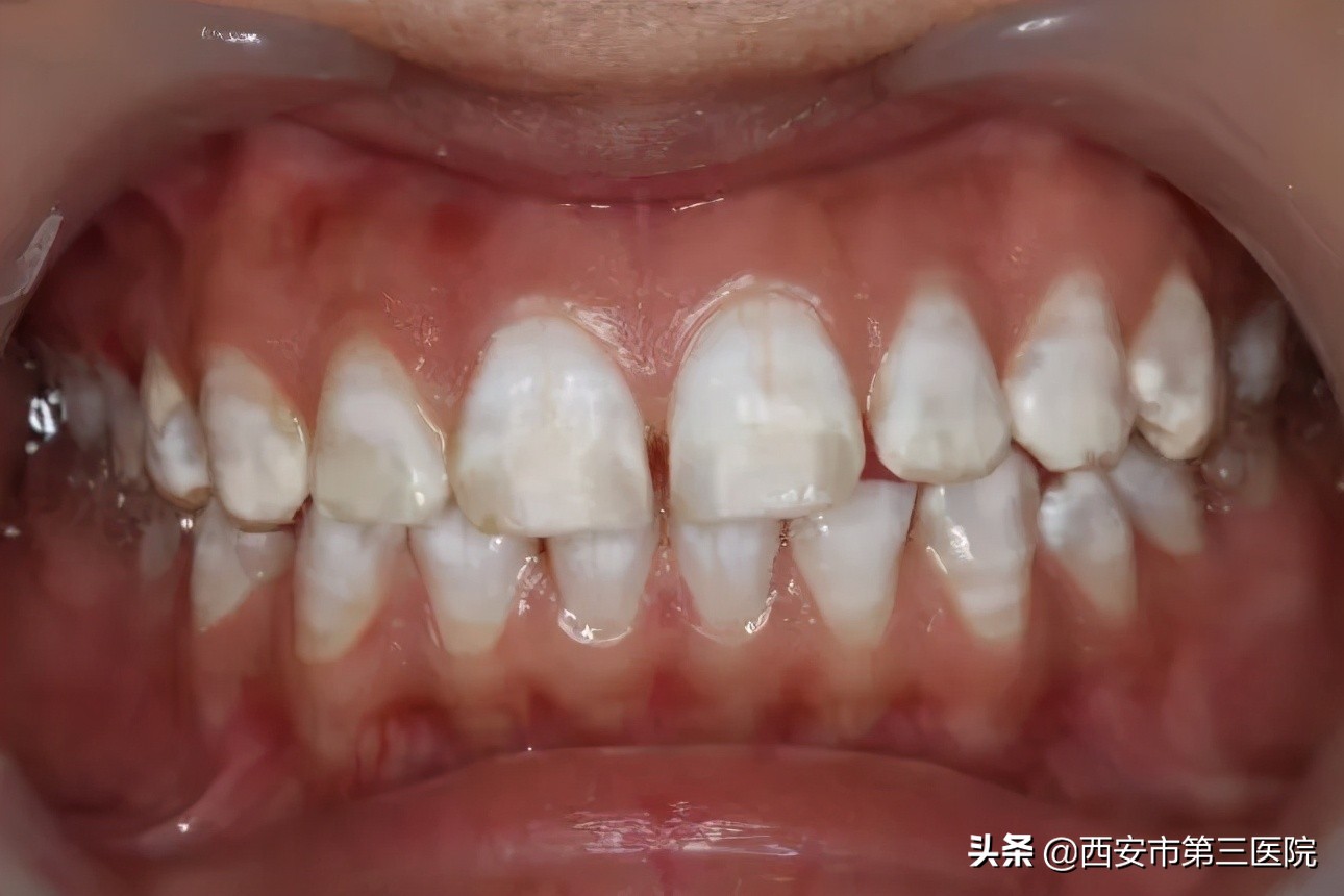 医学界公认的美白牙齿最好的方法,医学生教你牙齿美白小技巧