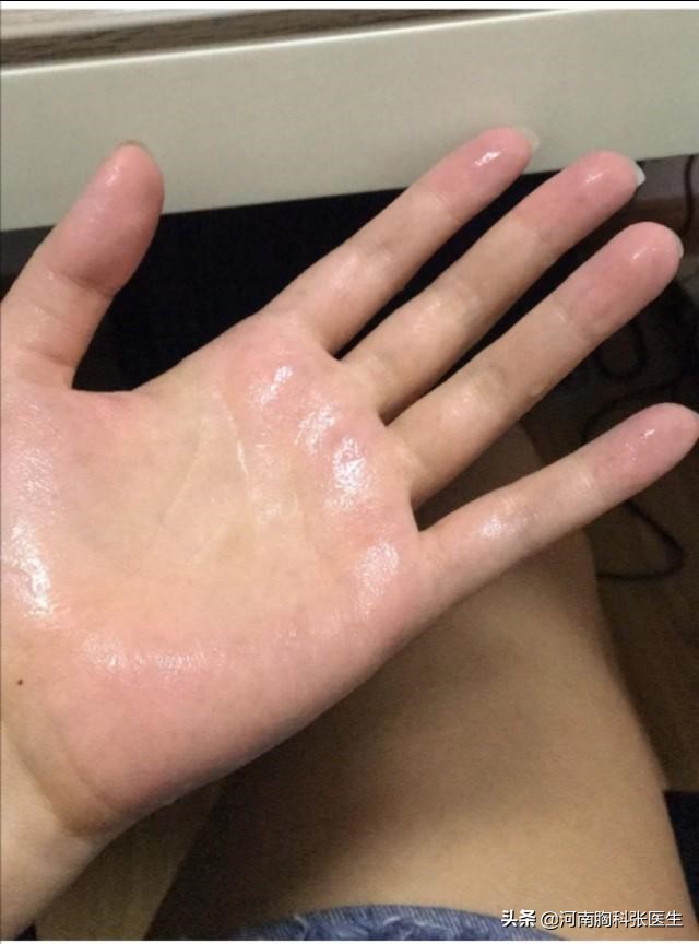 手汗症需要治疗吗,手出很多汗是什么病