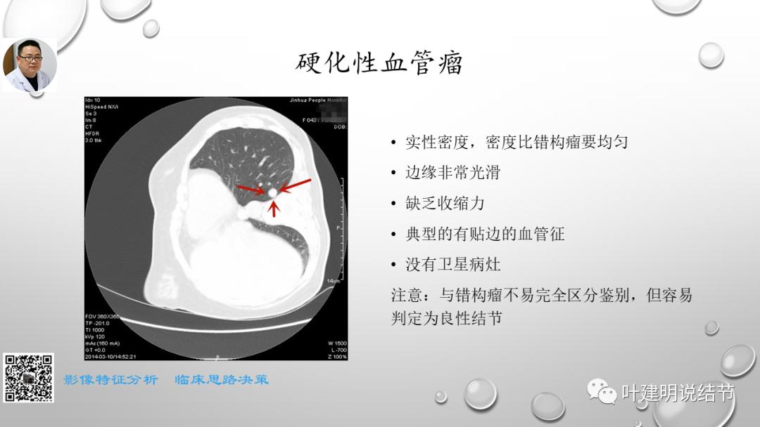 叶建明谈肺实性小结节视频,廖正银教授谈肺结节