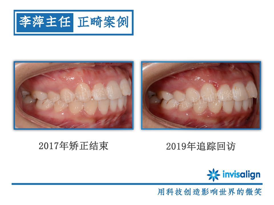太原隐形牙齿矫正哪家靠谱,太原李萍正畸怎么样