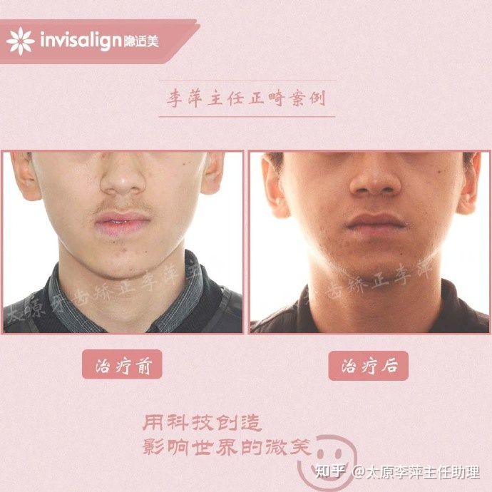 太原牙齿矫正靠谱吗,太原成人隐形牙套牙齿不齐