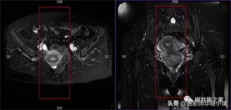 「精品课件」带大家看看，磁共振子宫MRI要如何扫描？