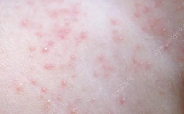 城市温度急剧上升,冬天温度高皮肤干燥瘙痒怎么办