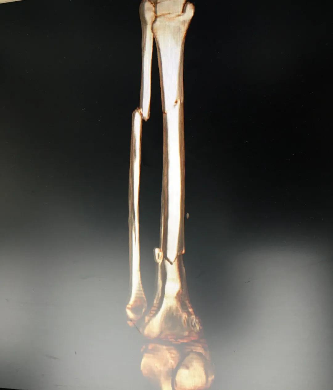 小腿挤压大量淤血能在家自愈吗,小腿碎成三截还能复原吗