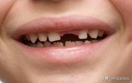 牙齿磕断一半特别疼能直接拔掉吗,牙齿磕掉了一点点需要补吗