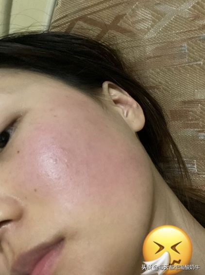 如何改善脸上皮肤特别薄，一直泛红，毛孔粗大，*血丝红**明显？