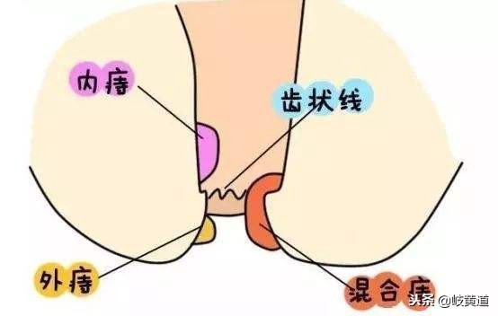 女性突然大便出血且鲜红不痛,肛门拉屎痛出血怎么治疗