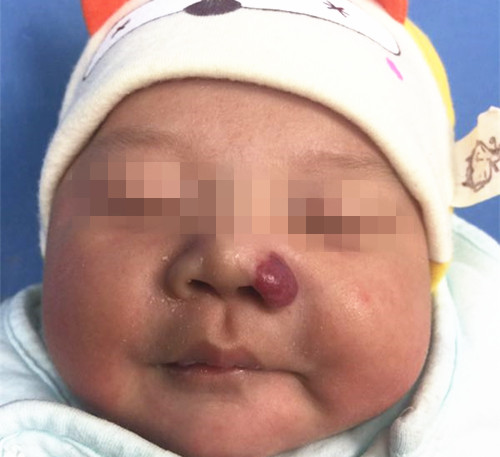 婴幼儿血管瘤长在头皮,婴儿血管瘤长在特殊部位