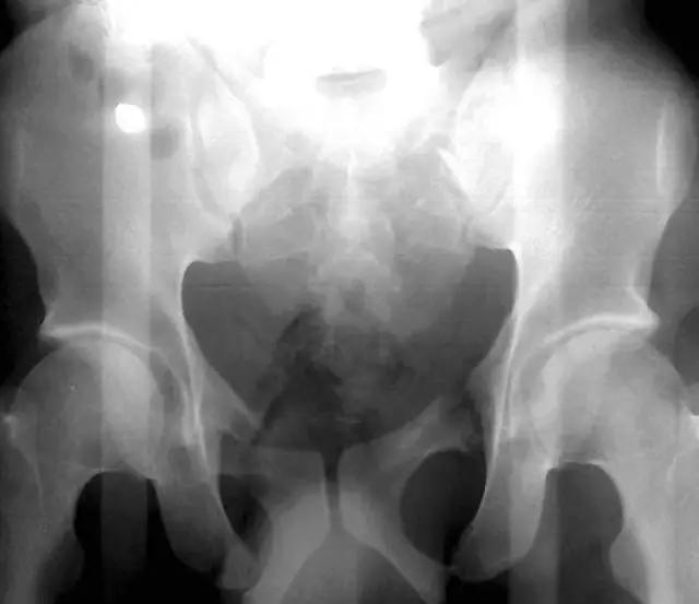 所有骨折都叫什么名字,骨折的名称有哪些